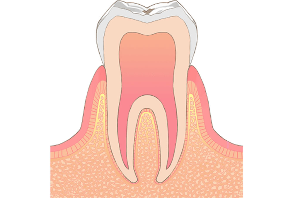 初期虫歯