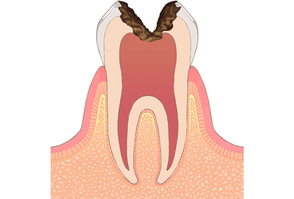 歯の神経にまで進行した虫歯