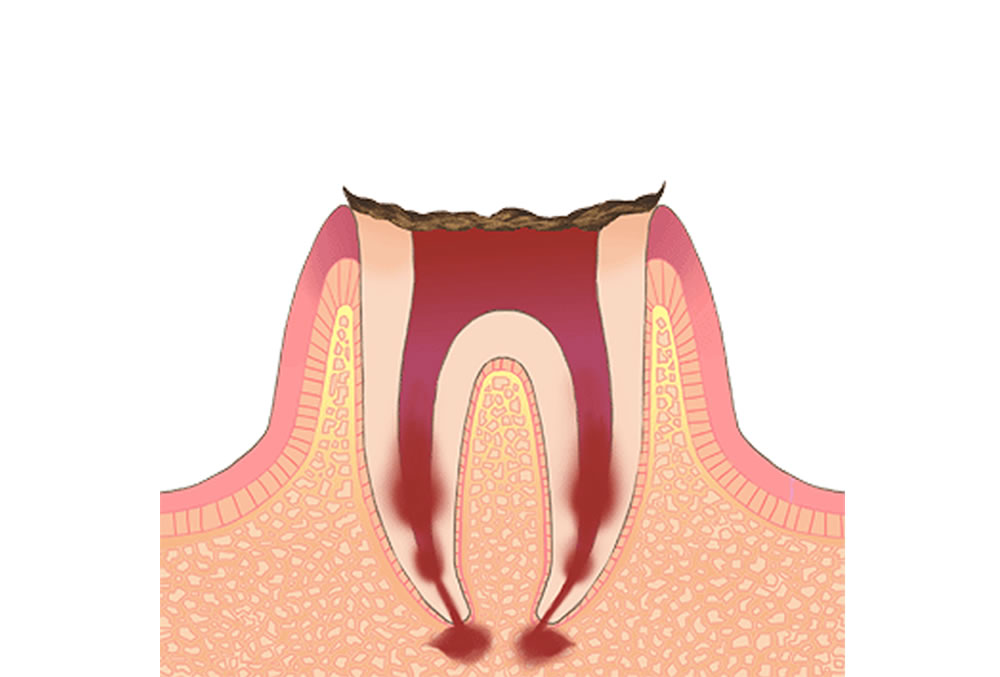 虫歯の分類と治療法　その２