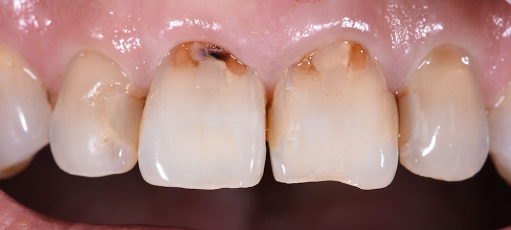 歯の表面が黒いのはぜんぶ「ムシ歯」なの？