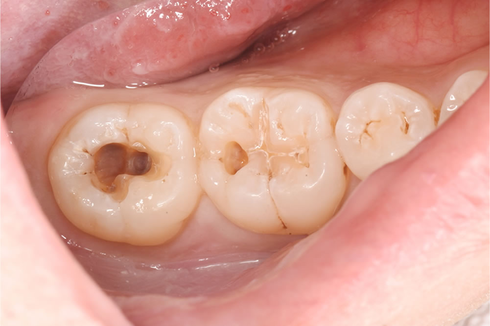 虫歯治療の実施