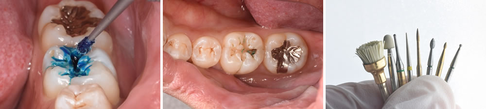 虫歯治療の実施