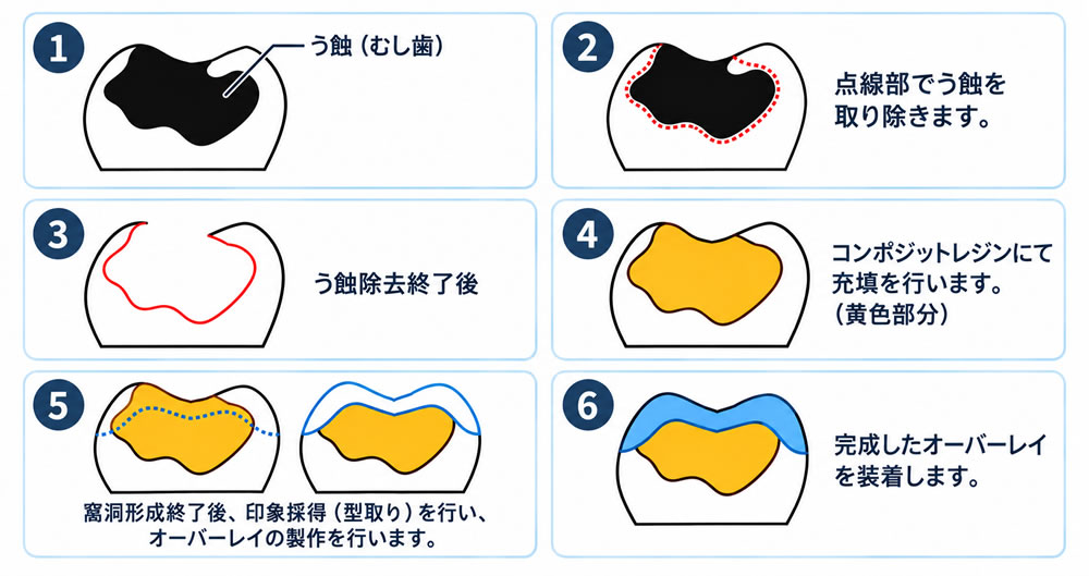 う蝕(むし歯)が大程度の場合 → オーバーレイ修復治療