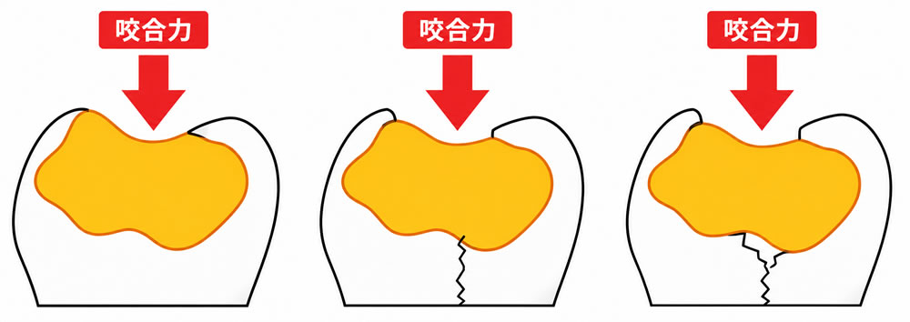咬合力によって歯が破折するメカニズム