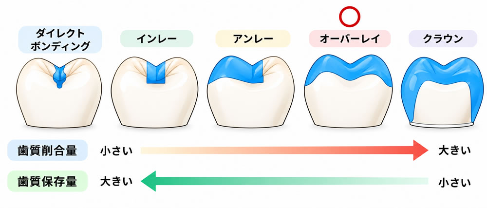 補綴物の種類と歯の切削量
