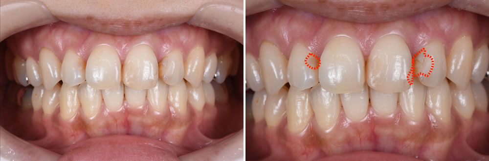 歯周病治療・PMTC（クリーニング）の実施
