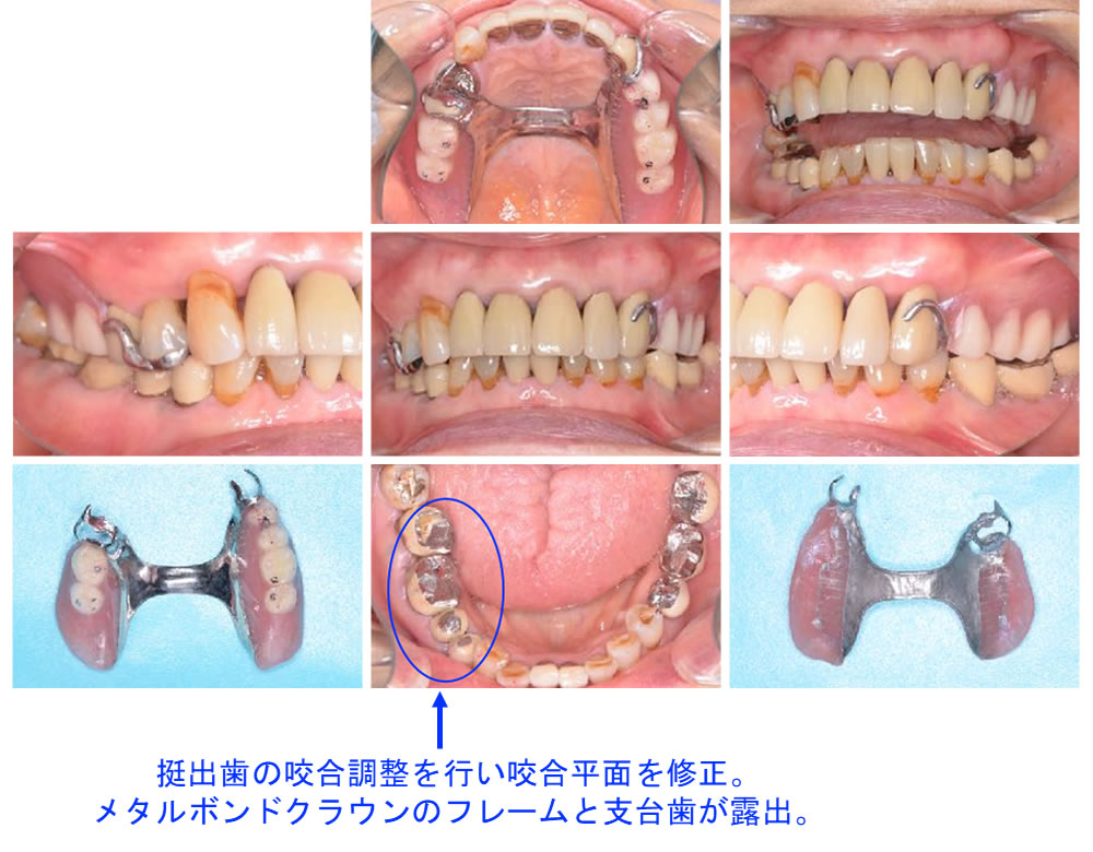 治療用部分床義歯の装着