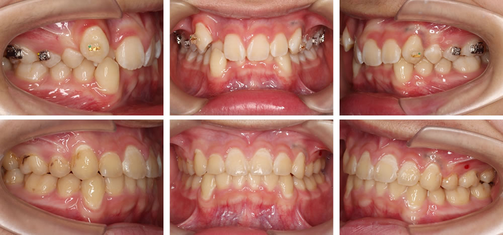 過蓋咬合矯正治療例
