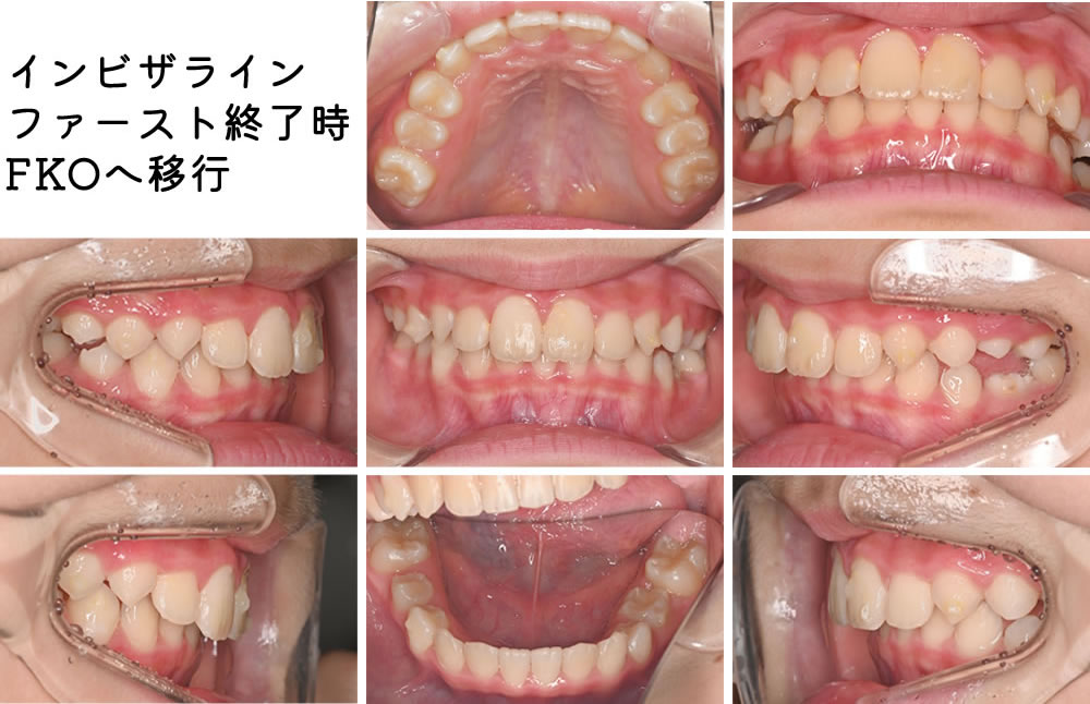 子どもの出っ歯の矯正治療例