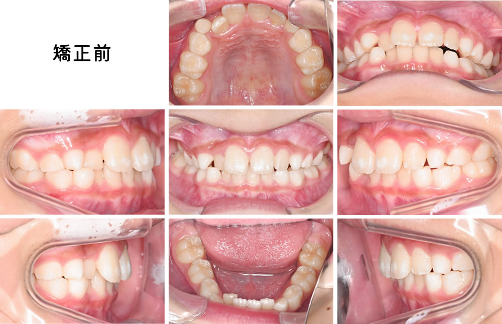 八重歯(叢生)の矯正治療例