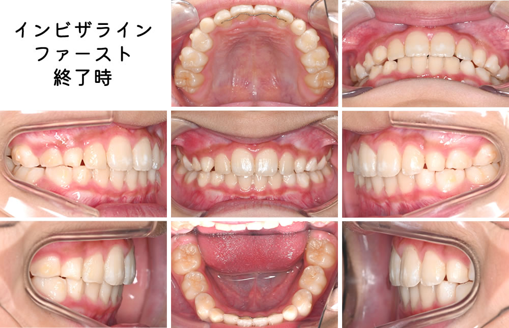 インビザラインファースト終了時