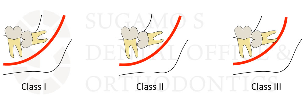 下顎埋伏智歯の分類方法