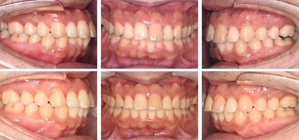 叢生矯正治療例
