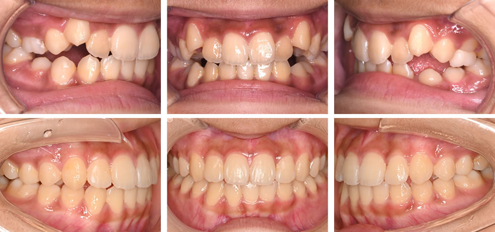 八重歯（叢生）の矯正治療例