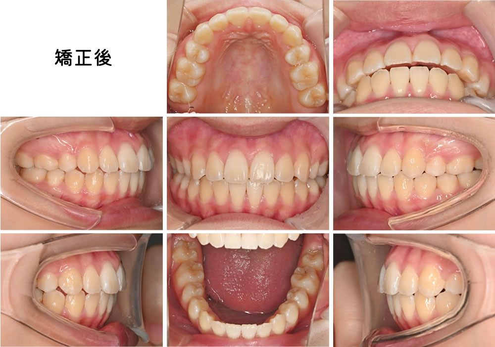 叢生矯正治療例