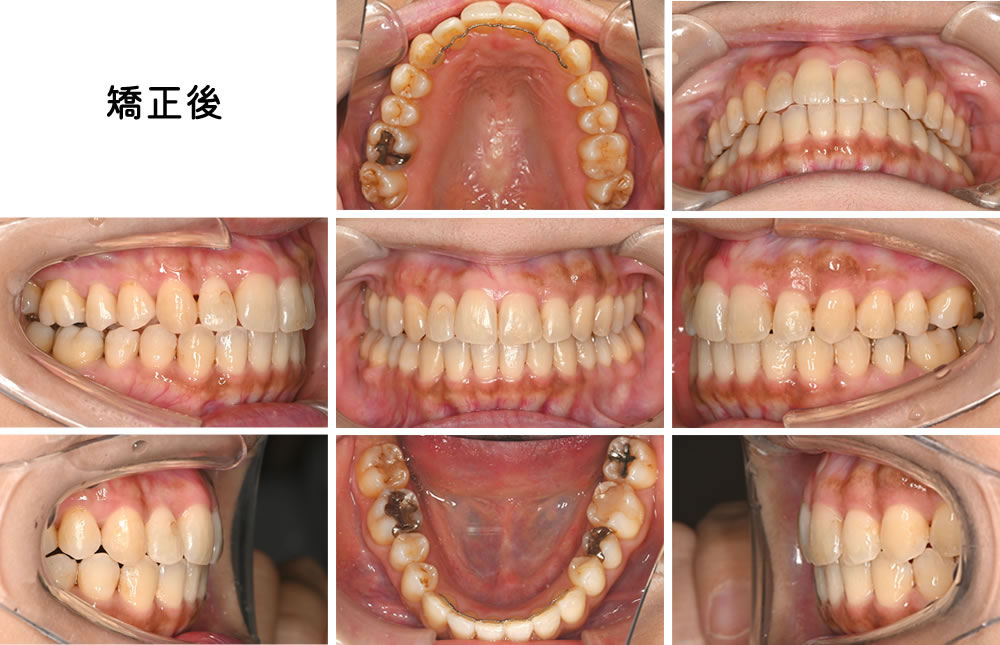 叢生矯正治療例