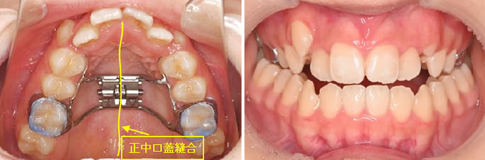 急速拡大装置(RPE)の装着
