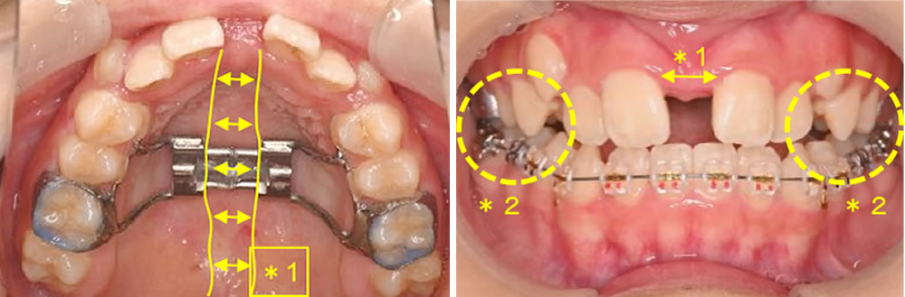 上顎歯列の拡大と臼歯反対咬合の改善