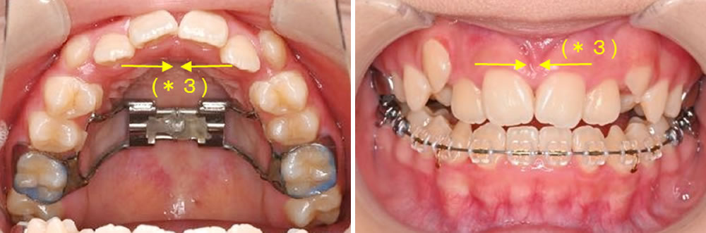 前歯部空隙の自然閉鎖