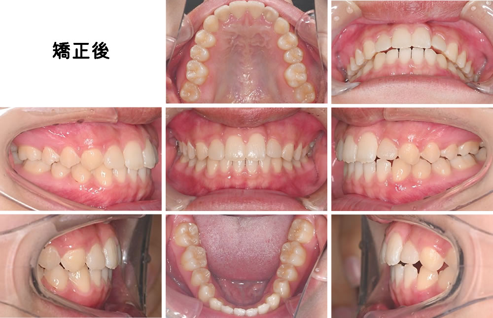 矯正治療完了