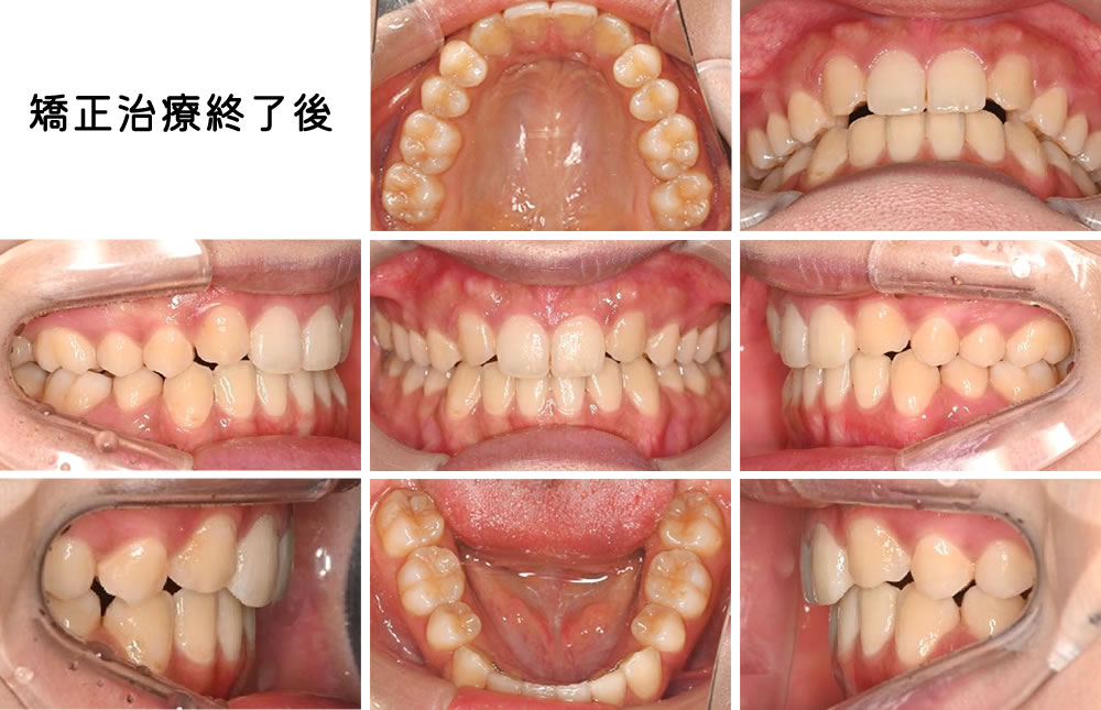 矯正治療終了後