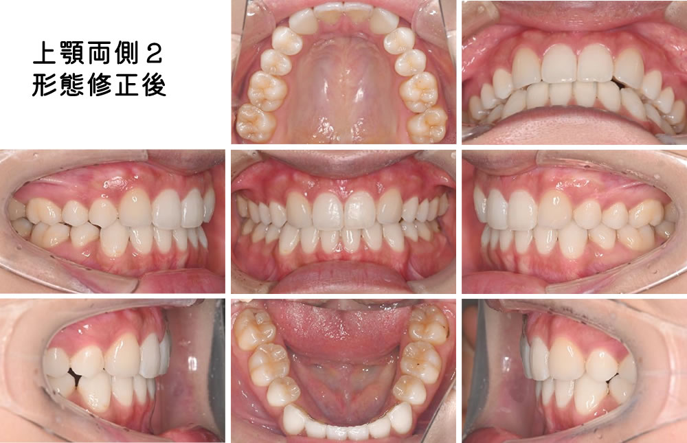 上顎両側2形態修正・治療完了