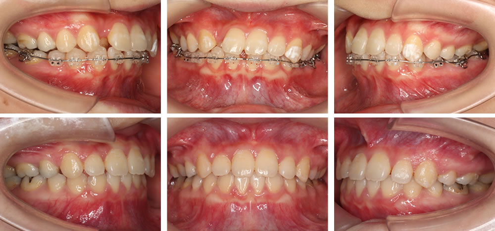 大人の空隙歯列・すきっ歯矯正治療例