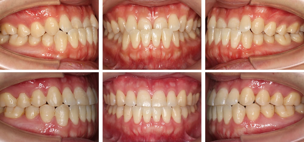 下顎前突・受け口矯正治療例