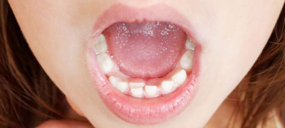 歯並びに影響するお口の機能について