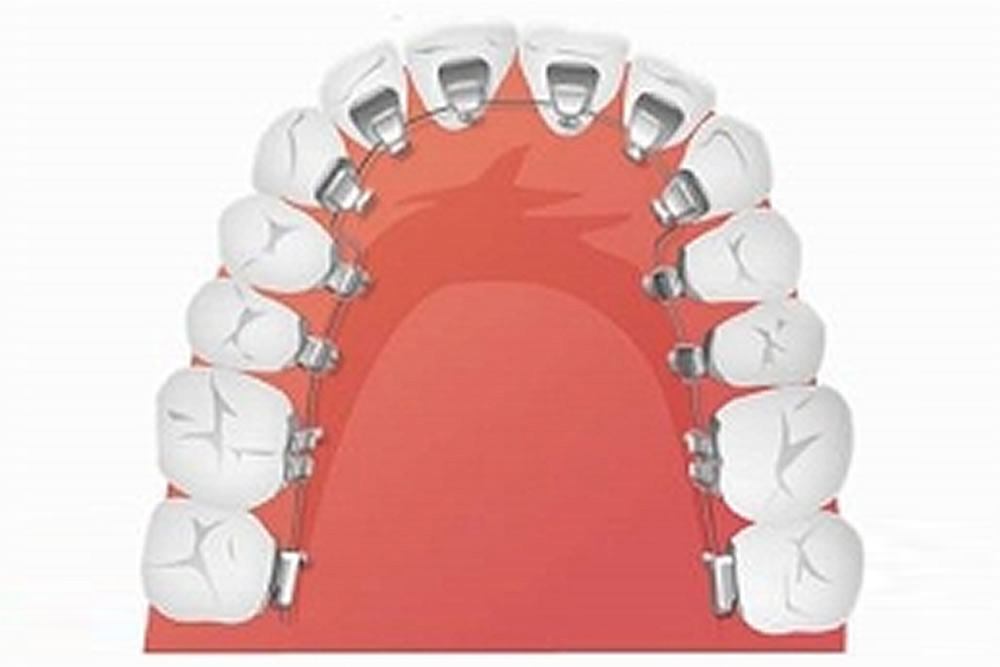 裏側矯正(舌側矯正)