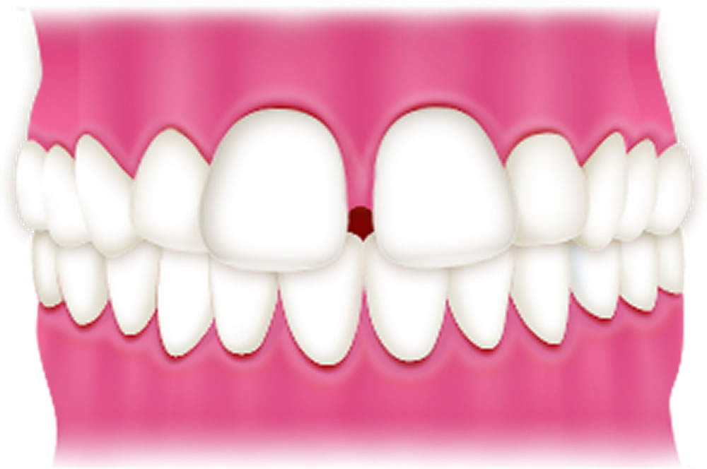 空隙歯列(すきっ歯)