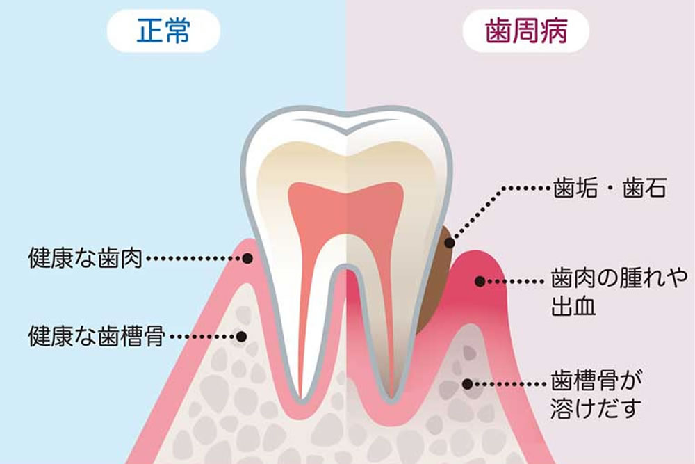 歯周病の症状・原因